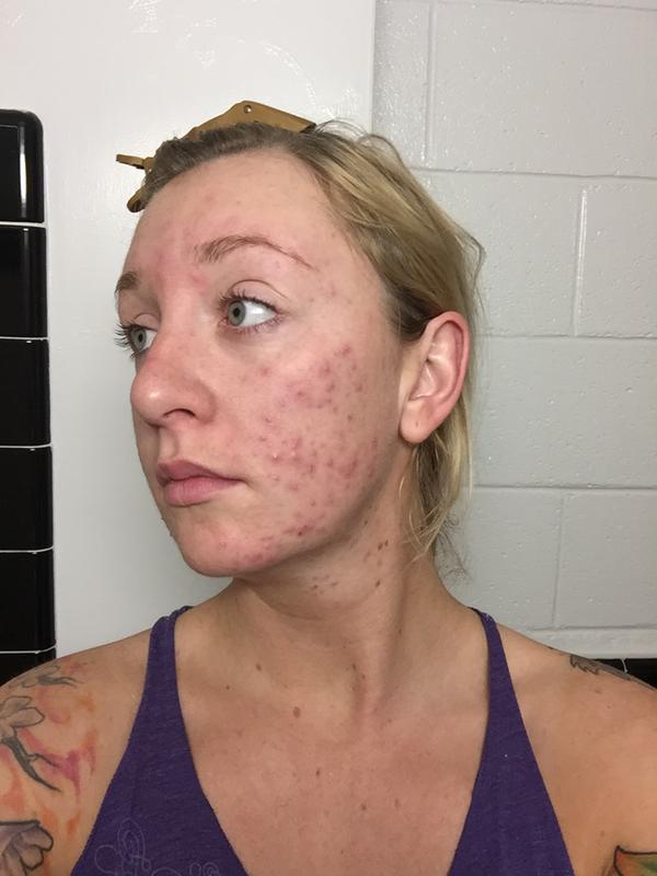 biore charcoal acne cleanser before and after