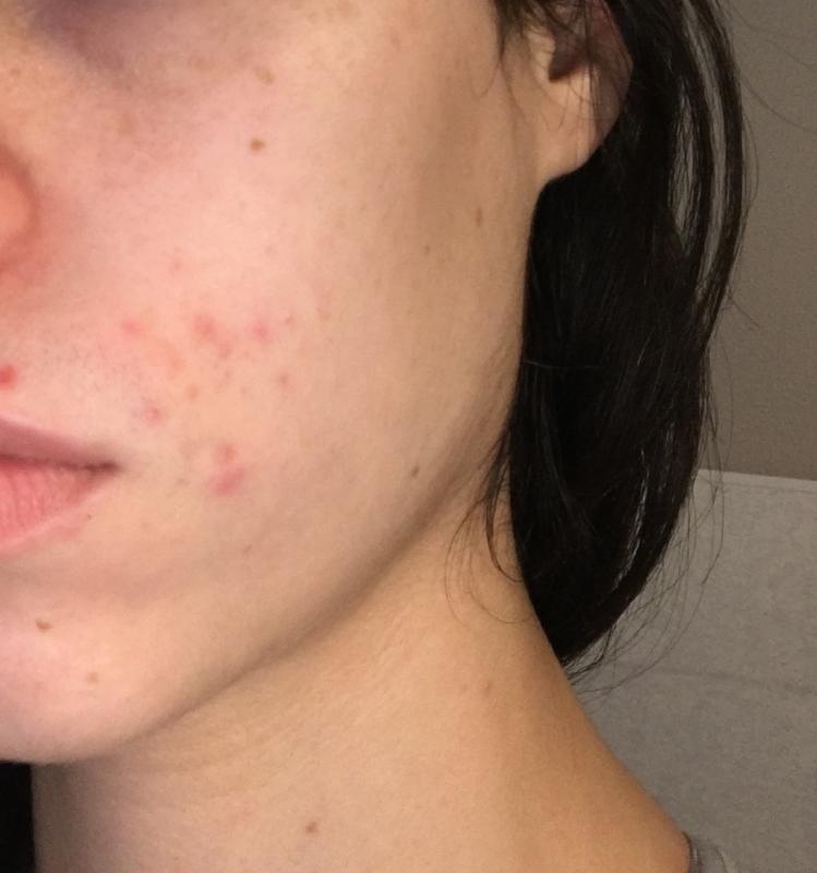 biore charcoal acne cleanser before and after