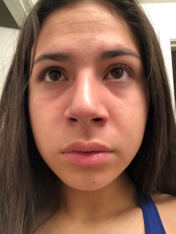 bioré charcoal acne clearing cleanser before and after