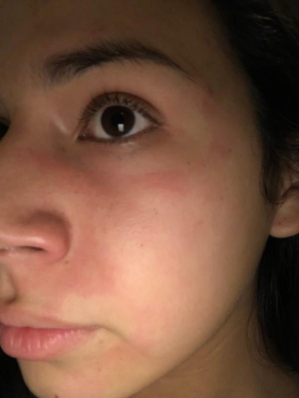 bioré charcoal acne clearing cleanser before and after